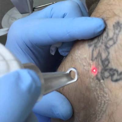 Процесс удаление татуировки лазером